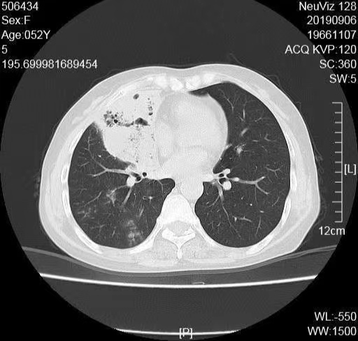 肺 ct 上如何一眼辨认肺炎克雷伯杆菌肺炎?答案看这里!