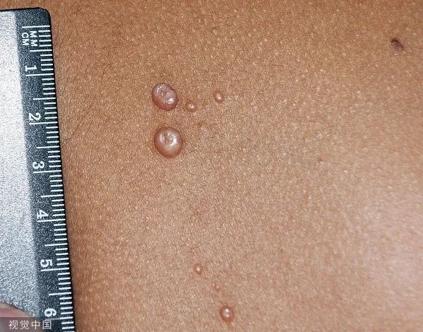 这是由痘病毒科的传染性软疣病毒感染引起的一种疾病.