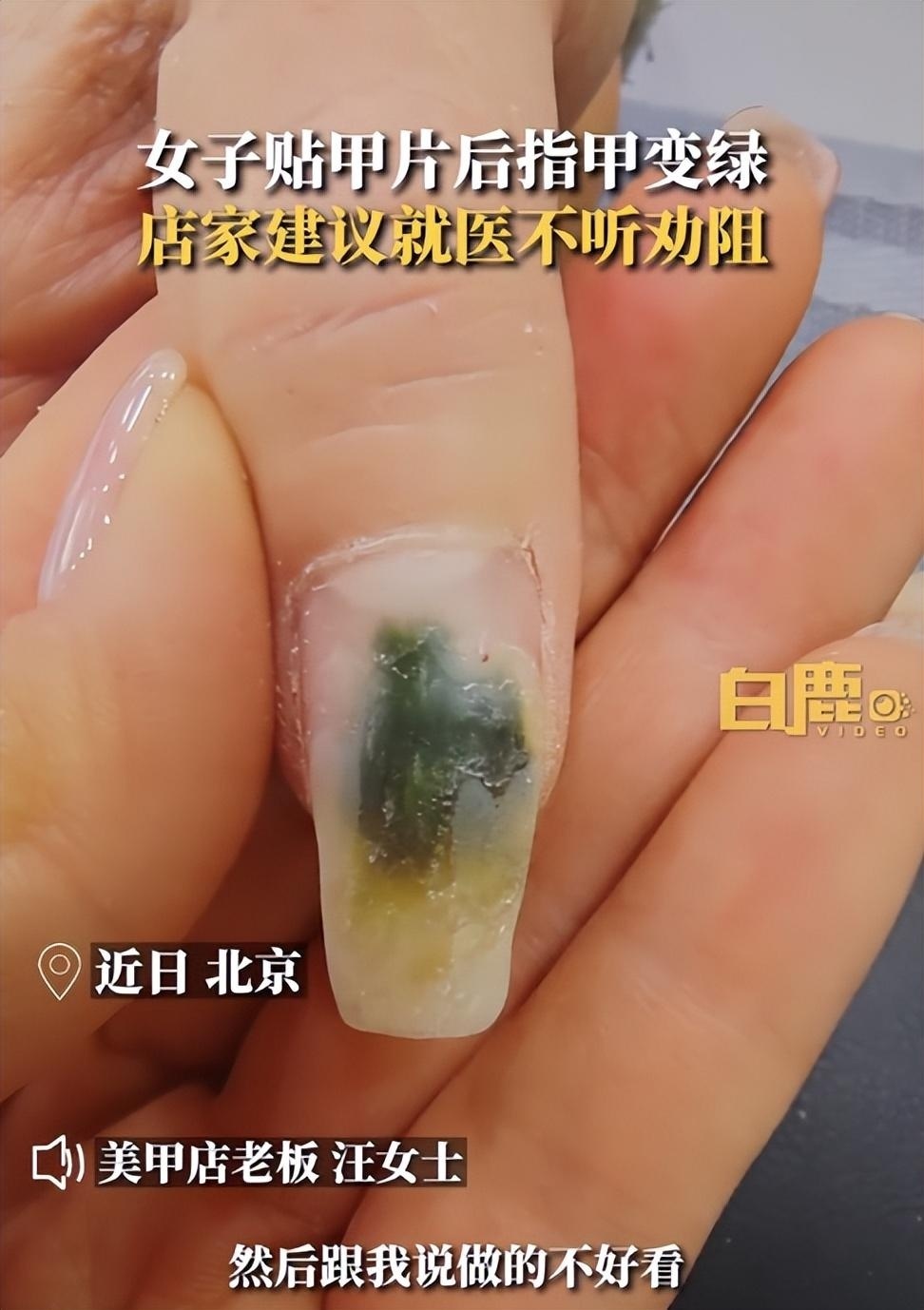 绿霉菌指甲图片图片