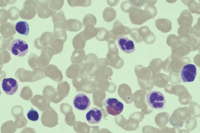 骨髓涂片瑞姬氏染色×1000检查意见:本次涂片示以粒系为主,有核细胞