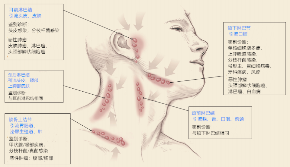 2,淋巴结肿大,发炎的表现?