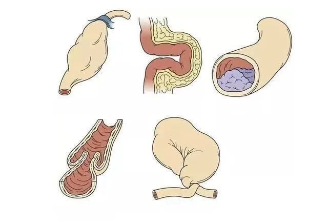 男子连吃3根生香蕉致肠梗阻,如何避免