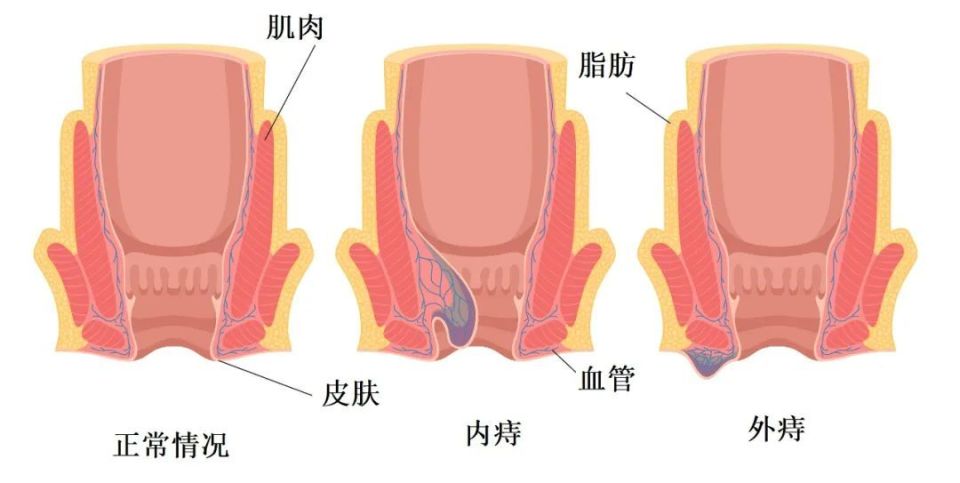 小孩长痔疮图片图片