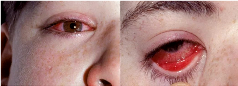 这个病毒号称"毒王",当前儿童感染概率高,无特效药