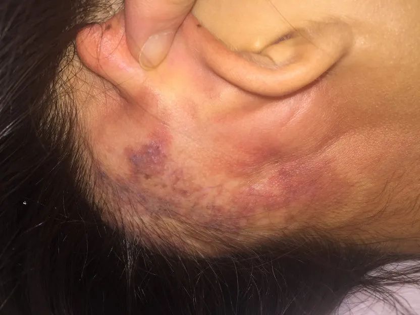 【首儿所蒲公英科普】血管瘤"家族"中的-动静脉畸形(蔓状血管瘤)