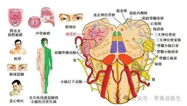 前庭神经核位置图片