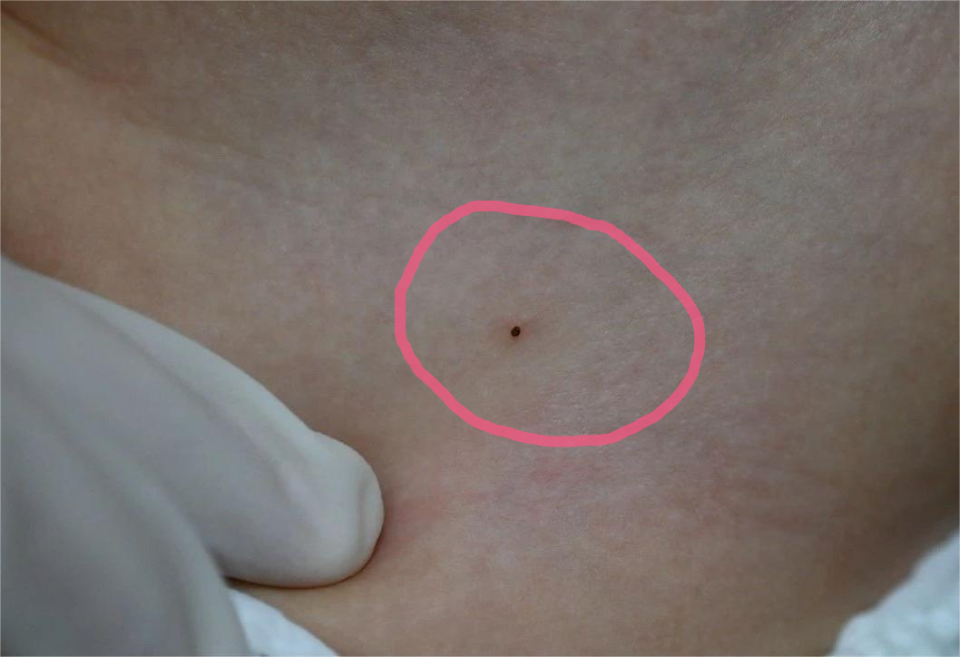 两名儿童遭蜱虫叮咬身现小黑点 医生:蜱虫携多种病毒,严重可致命