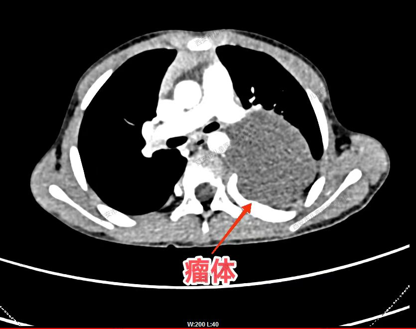 "小"胸腔,"大"肿瘤——我院胸外科完成了92例胸腔镜下纵隔肿瘤切除