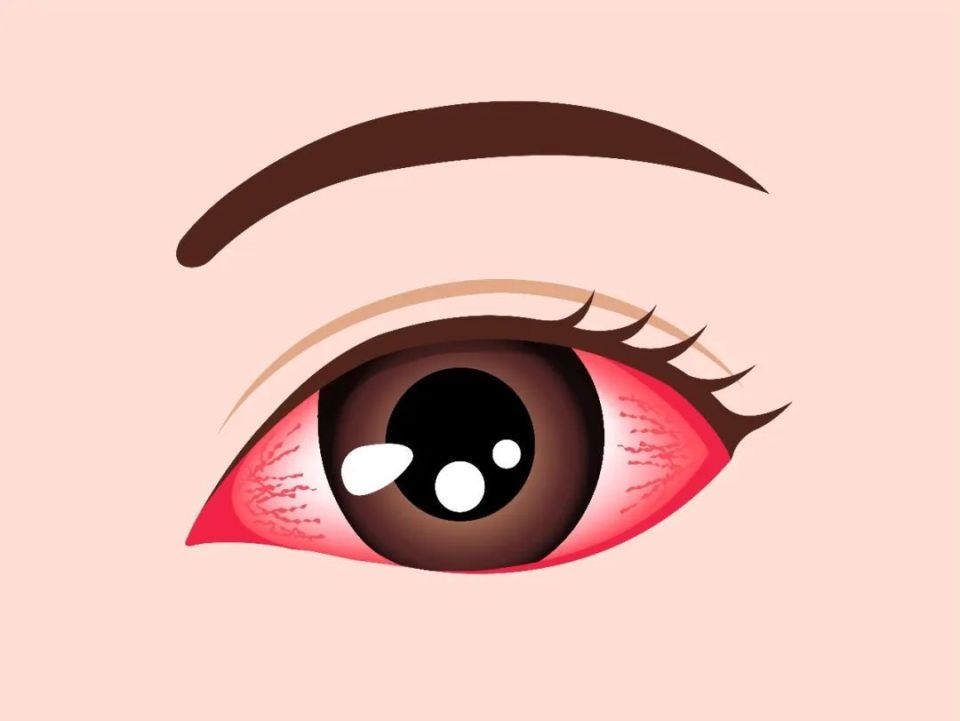 "红眼病"往往是人们的俗称,主要症状均是眼睛发红,干涩,眼痒,疼痛等