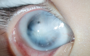 "主要是孩子的右眼角膜白斑比较严重,阻挡了光线的进入"王伟主任解释