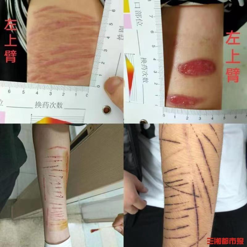 警惕"非自杀性自伤"行为_腾讯新闻