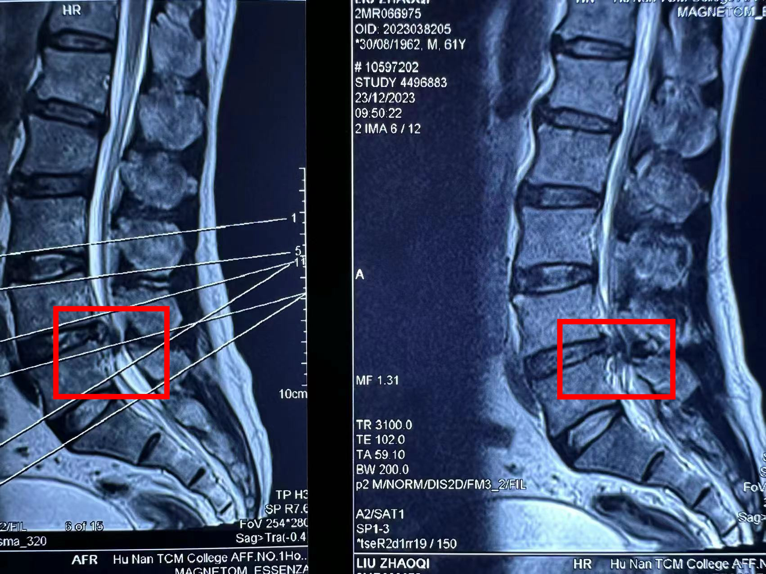 原来,刘先生突然出现的小便排出困难是因为腰椎管内血肿压迫导致马尾