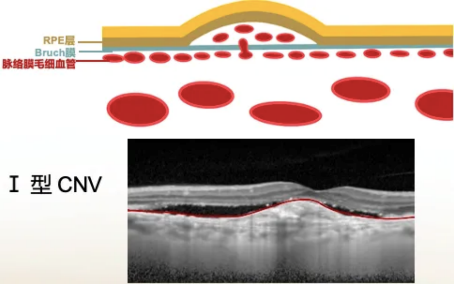 眼底新生血管图片