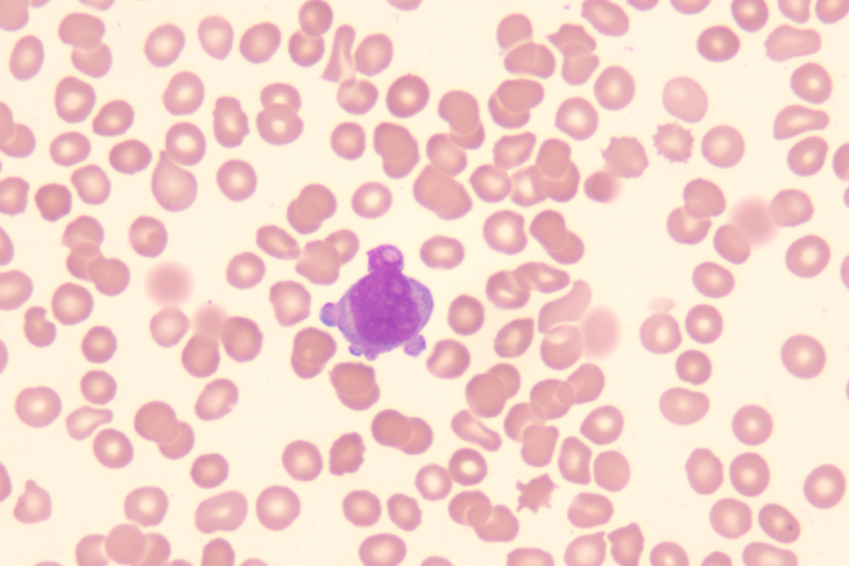 血常规用什么仪器检查患者入院要求弃胎，万万没想到血常规竟隐藏了 1 个致命信号！_https://www.jmylbn.com_新闻资讯_第5张