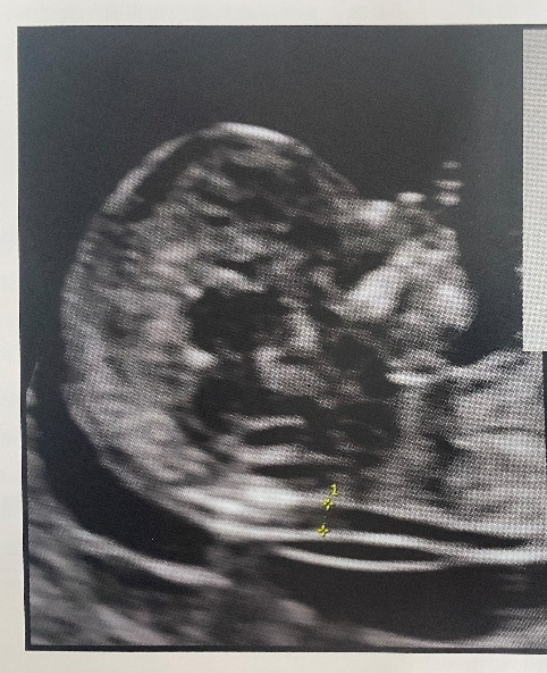 颈项透明层 > 2.5 mm,孩子还能要吗?