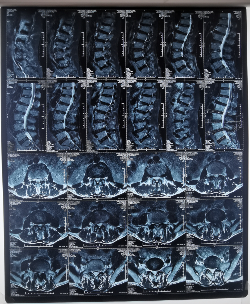 院内首例∣延安市人民医院骨科一病区巧用3d打印多孔