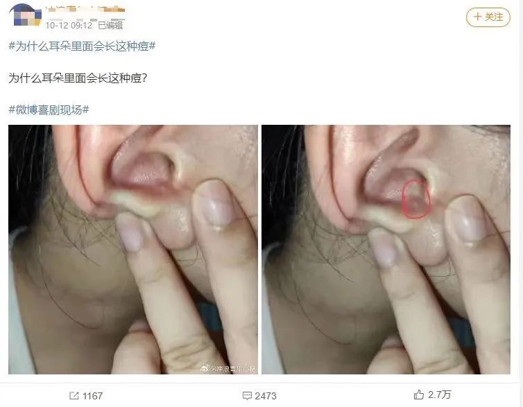 "外耳道疖"别挤!别挖!根据网友上传的