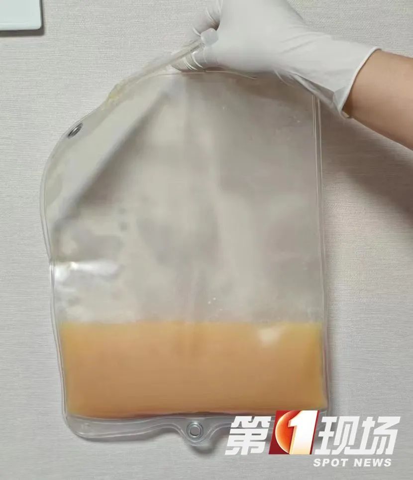 夏天管不住嘴狂炫冷饮,男子入院抽出400毫升"牛奶血 "