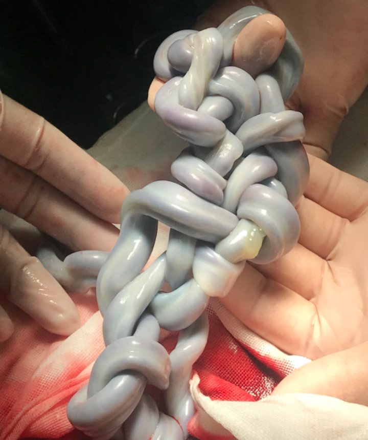 剖宫产发现近 10 个脐带真结,产前这个检查万万不能忽略!