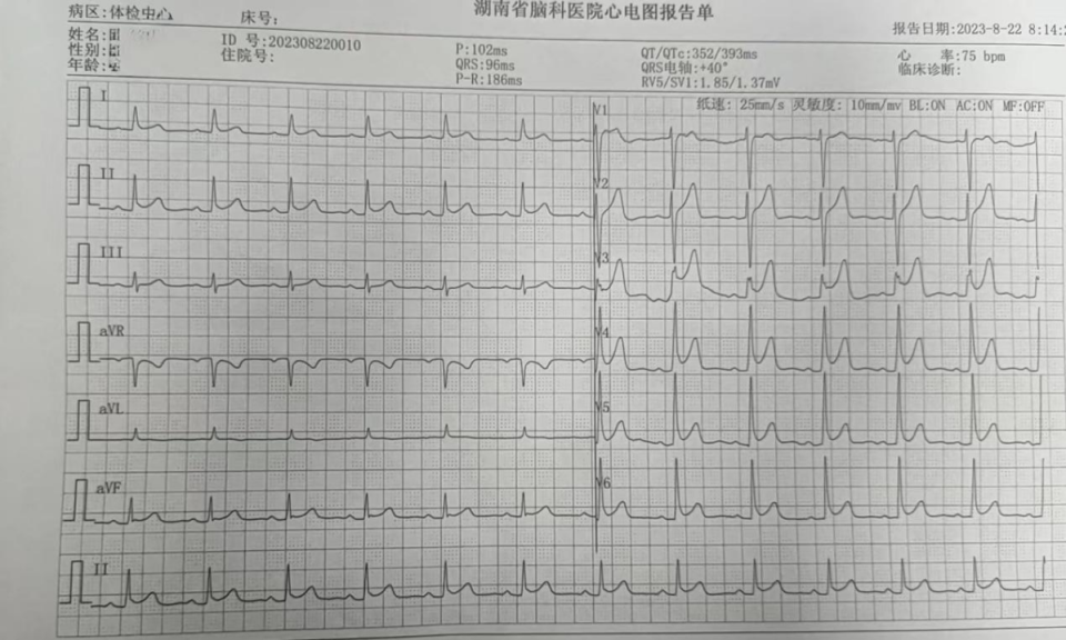 这种心电图类似急性心梗,需定期复查!约2%的健康人群可能出现