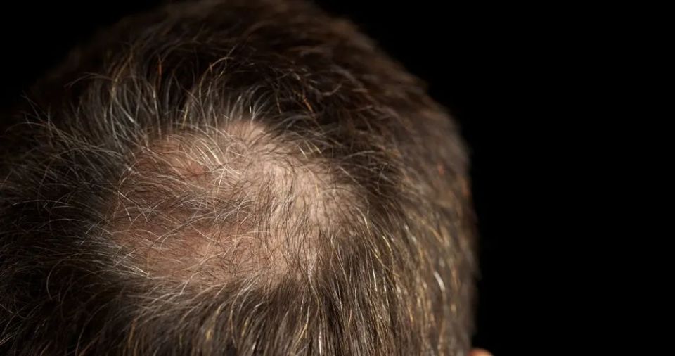 会有明显的发际线后移,秃顶;而女性相对较轻,发际线一般不后移,但头顶