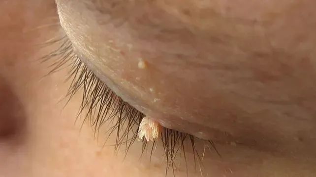 脖子上长这种小肉粒,不是普通皮肤病,可能感染了hpv!