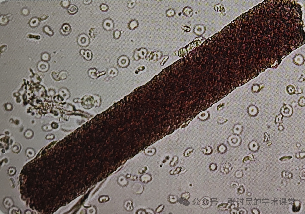 张时民老师解读:泥棕色管型