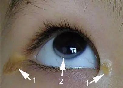 EV是什么针第一批90后已经高血脂！打一针管半年的降脂新方法来啦_https://www.jmylbn.com_新闻资讯_第3张