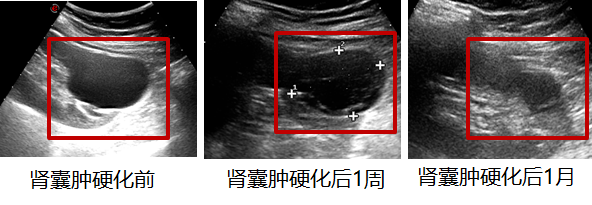 体检发现肾囊肿?