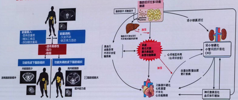 王友发教授:肥胖作为心血管-肾脏-代谢综合征的驱动因素 | 2024 北大