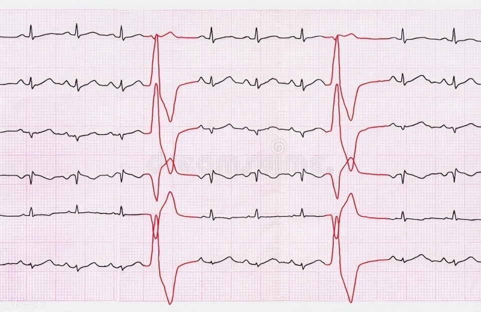 如果出现房颤等心律失常,会出现脉搏短绌,也就脉搏少于心率的现象