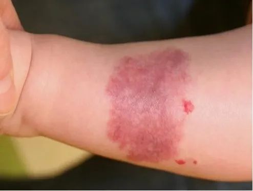 每年数以万计新生儿出现这种「红色胎记」,治疗要趁早!