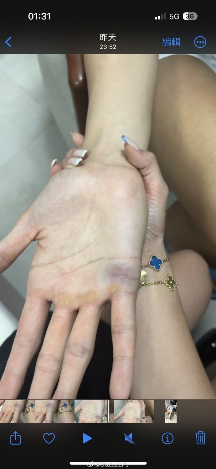 沈梓捷女友晒大鸟接受治疗的照片坚持从来不易