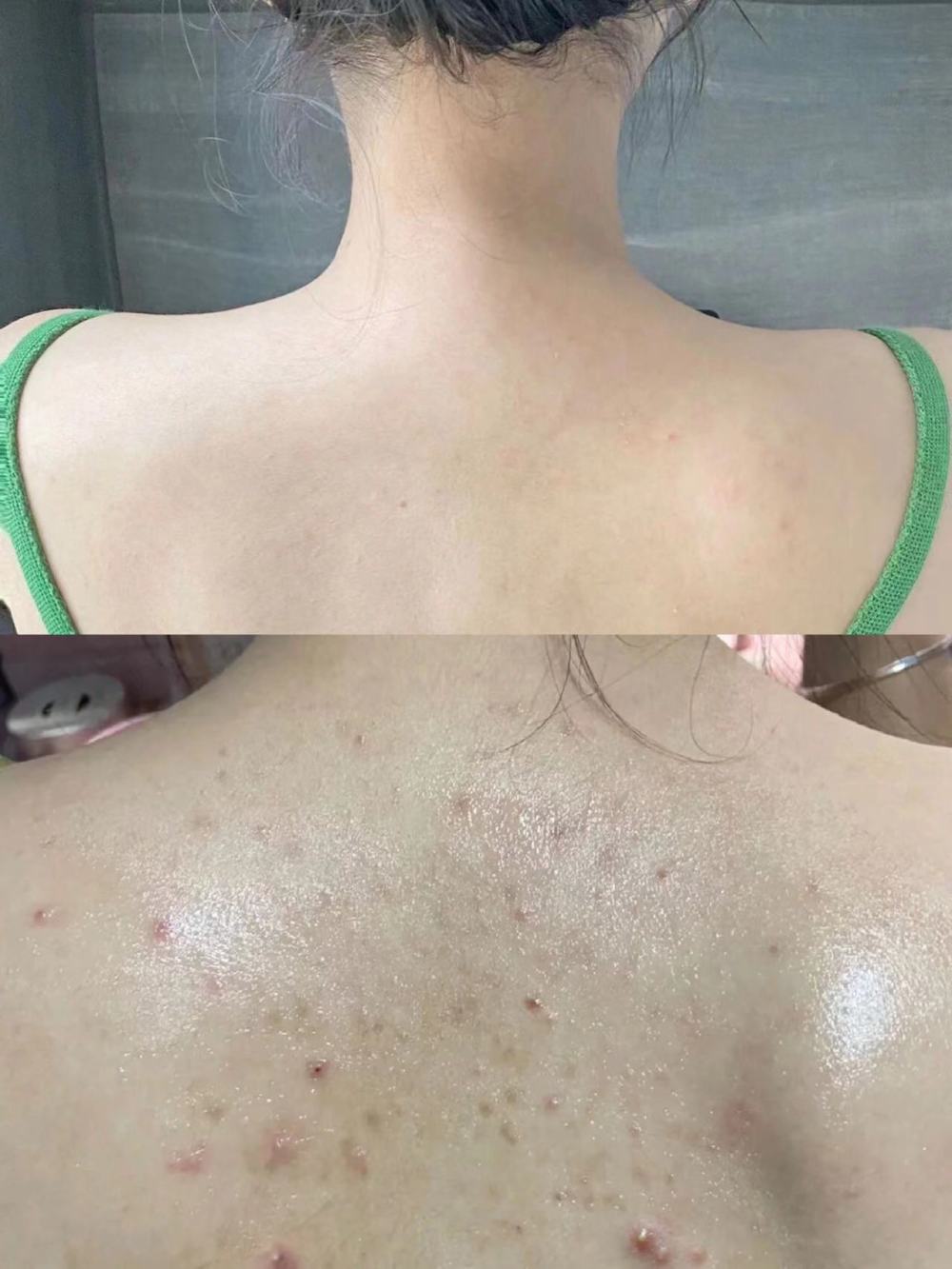 毕竟皮肤螨虫过敏敏感脆弱,所以一定要避免直接与螨虫接触,我是只要有