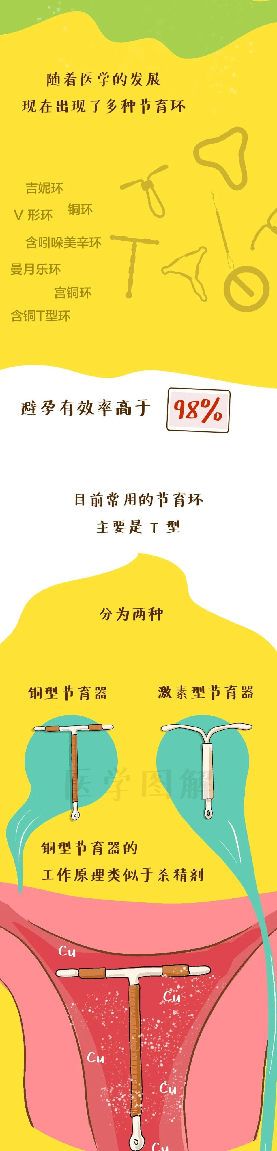 中国女性使用了全世界2/3的节育环,这个体内的"定时炸弹",你还记得吗?