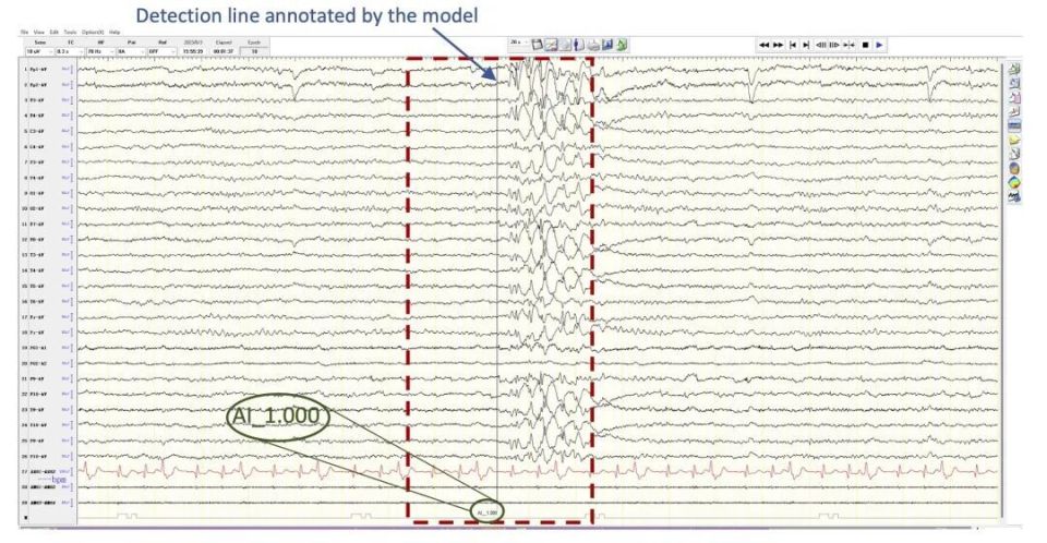 协和神经科团队研发基于多模态技术的人工智能检测癫痫样放电模型