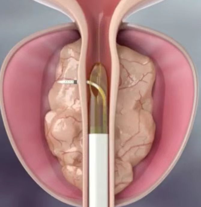 前列腺增生微创手术图图片