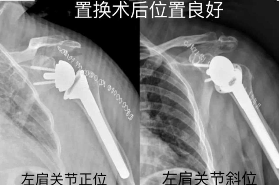 六旬大娘肩袖撕裂医生帮他关节反着装