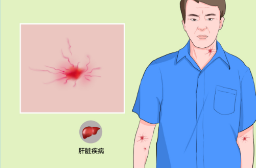 蜘蛛痣常見於肝炎,肝硬化,肝癌的病人.