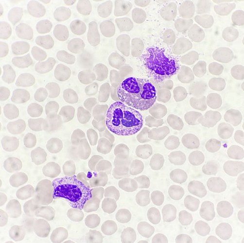 嗜酸性粒细胞增高你遇到这种疾病么