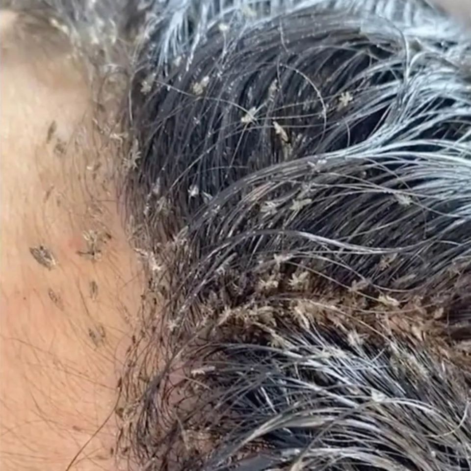 大部分毛发,原本寄生在头部和裆部的虱子无法再自由移动到其他部位