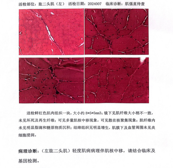 呼吸机怎么打开Ⅱ型呼吸衰竭又陷诊断困局……当室速撞上呼吸“牢笼”，如何通过破解隐匿的神经肌肉密码打开思路，拨云见日？丨疑案探密（161）_https://www.jmylbn.com_新闻资讯_第9张