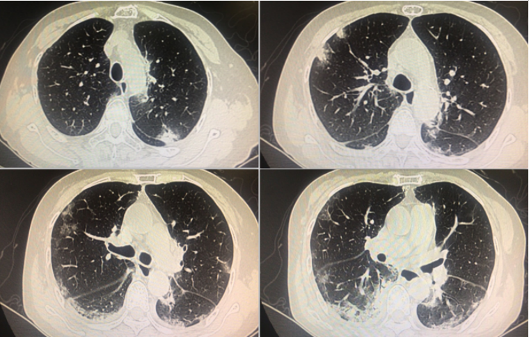 mngs在抗合成酶综合征合并间质性肺病诊治中的应用,3个实际病例有何