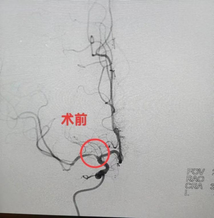 进一步给予脑血管造影检查,结果示右侧大脑中动脉m1段重度狭窄,左侧