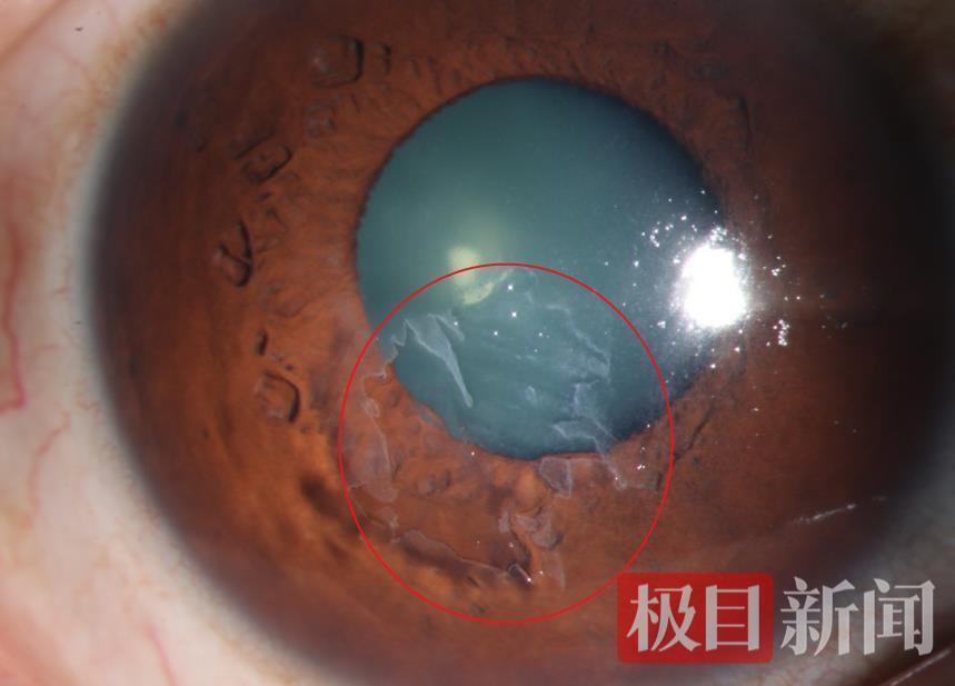 梧桐絮飞入眼,女子角膜破了层皮