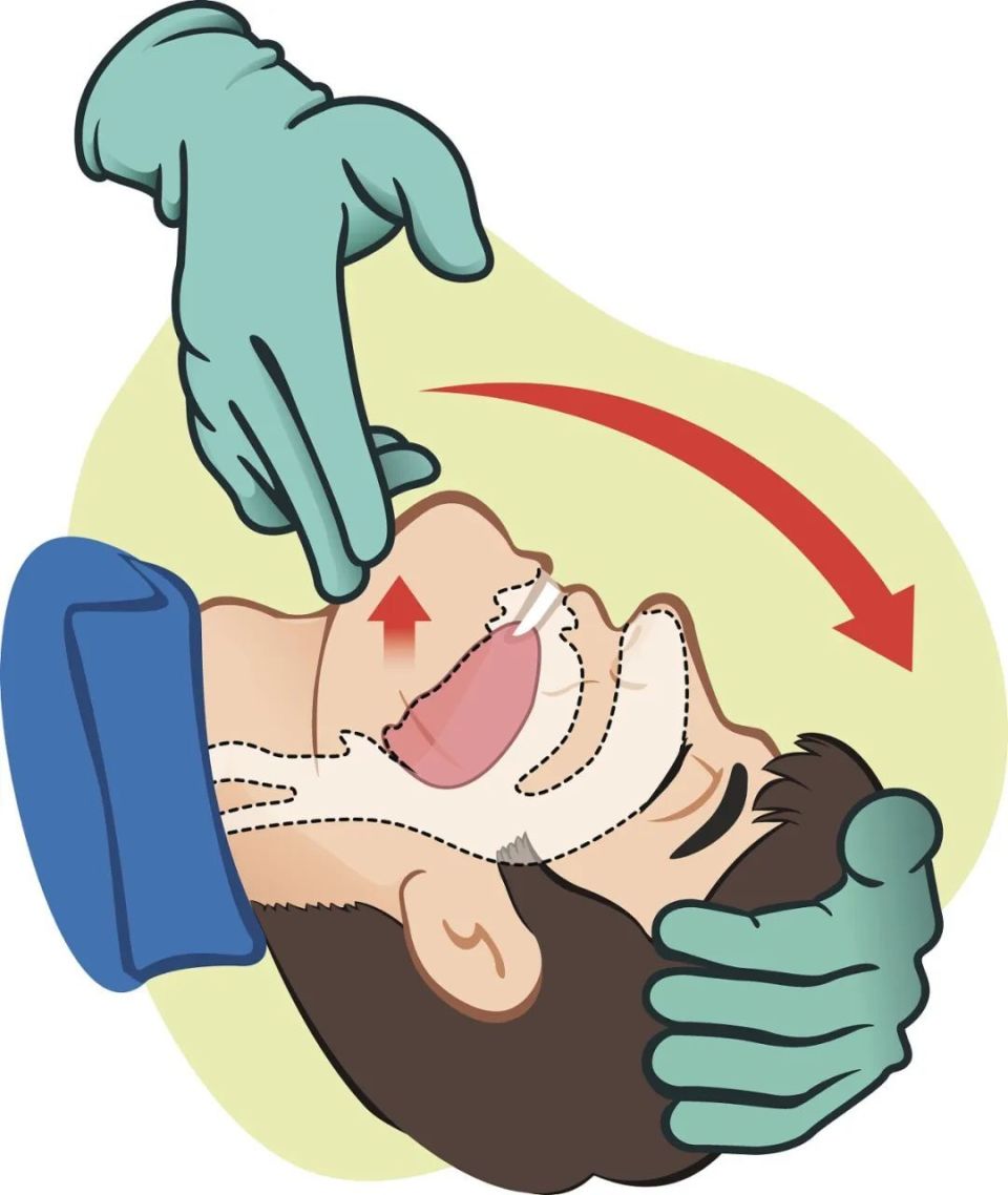 急救科普 | 心肺复苏(cpr)全攻略_腾讯新闻