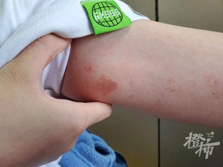 "猫感染猫藓后,轻症没有症状,甚至不会瘙痒.
