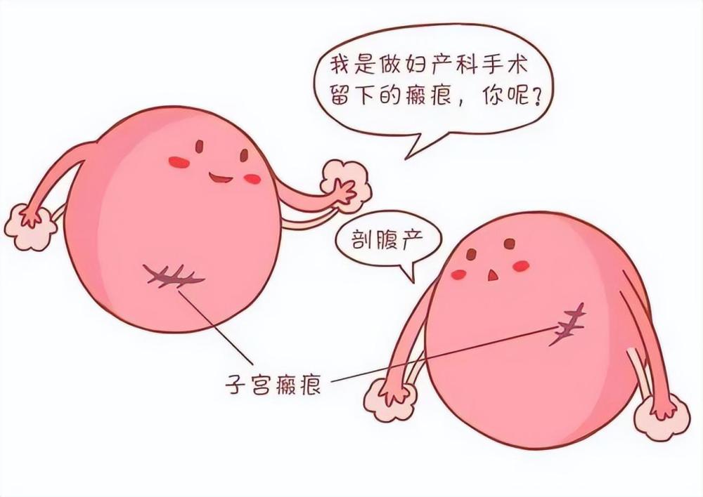 孕期子宫破裂,母子都危险!3个预防方法学起来,避免悲剧出现_腾讯新闻