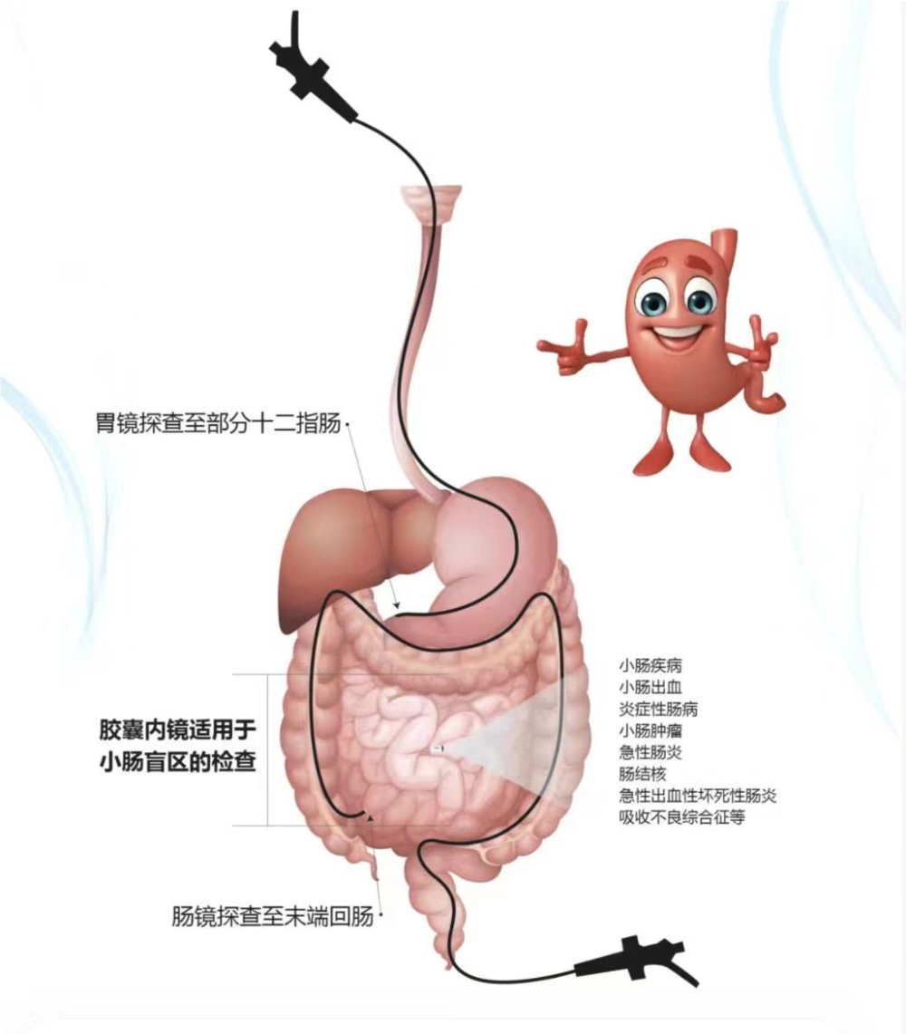胶囊内镜是消化道内镜检查的一种,常用于小肠疾病的诊断,肠道准备好后