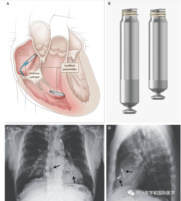 全球首款双腔无线起搏器获批fda